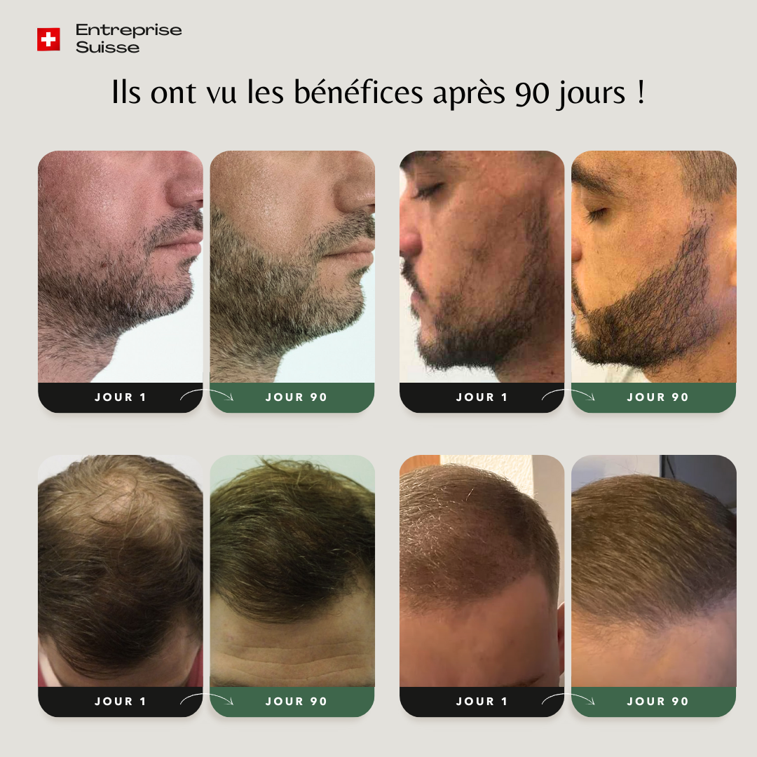 Dermaroller croissance cheveux et barbe